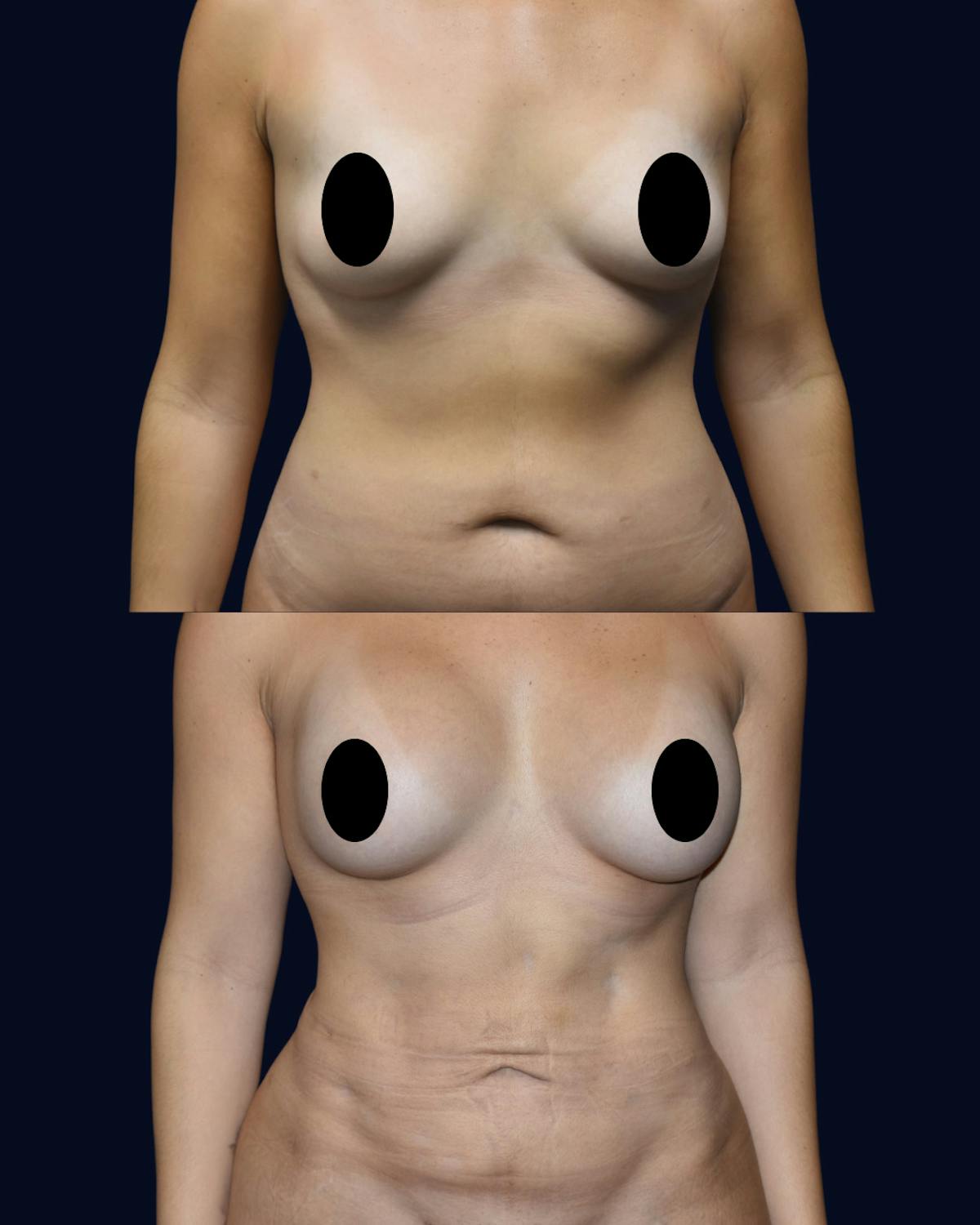 Breast Augmentation Before & After Gallery - Patient 342950 - Image 1