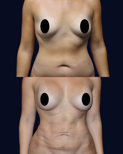 Breast Augmentation Before & After Gallery - Patient 342950 - Image 1
