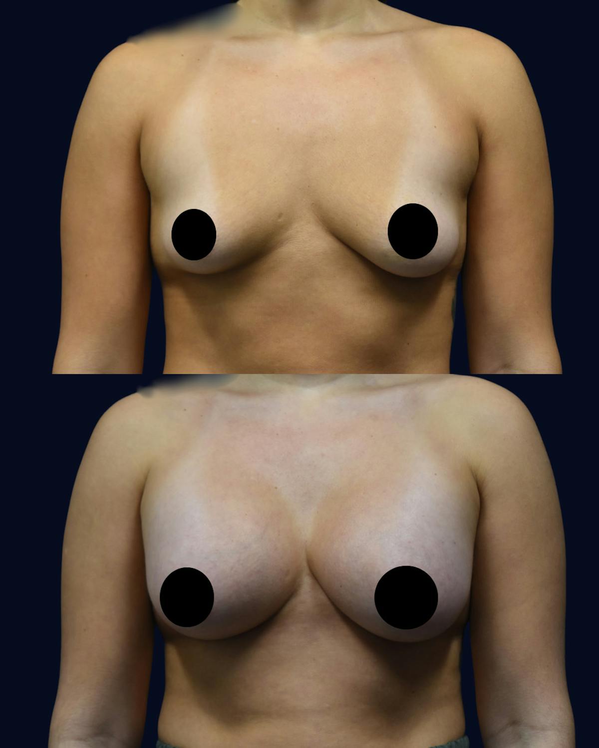 Breast Augmentation Before & After Gallery - Patient 358641 - Image 1