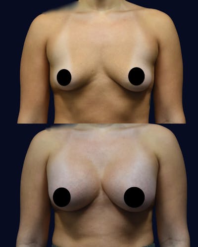 Breast Augmentation Before & After Gallery - Patient 358641 - Image 1