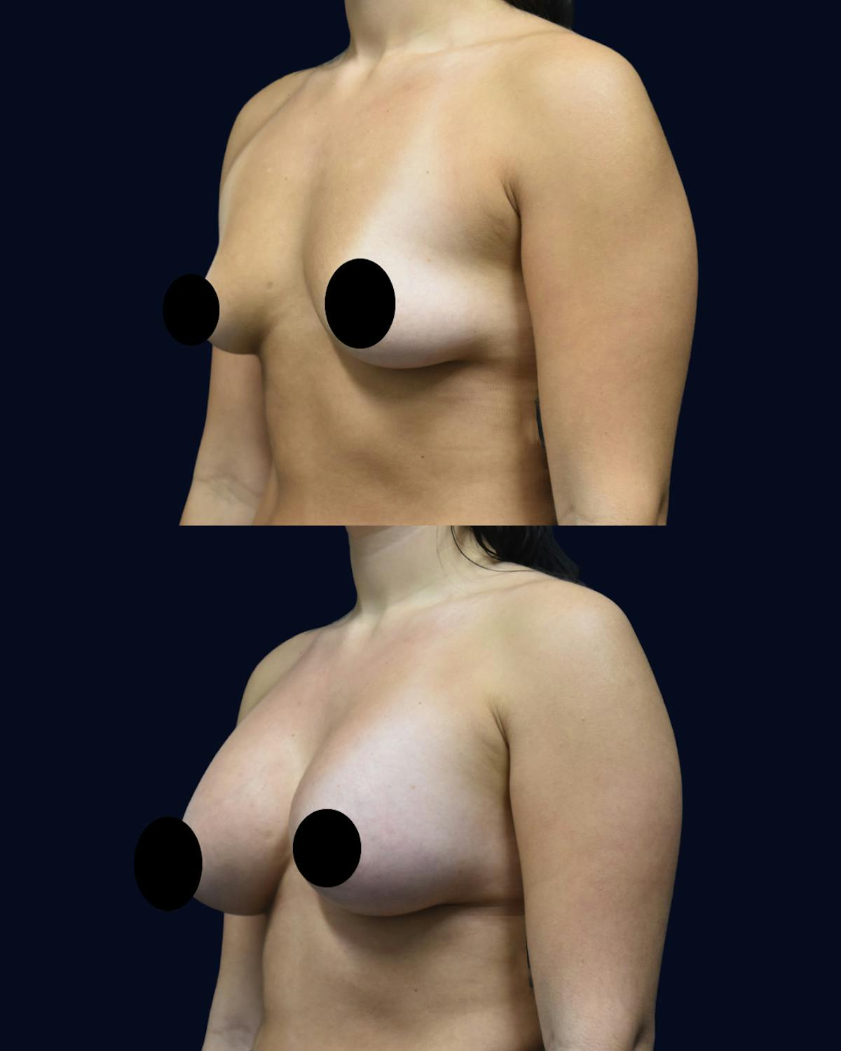 Breast Augmentation Before & After Gallery - Patient 358641 - Image 2