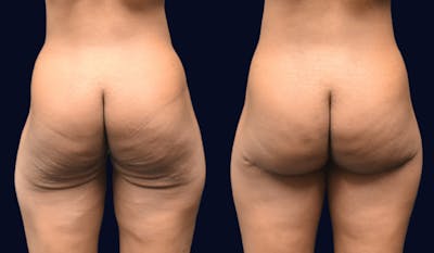 Brazilian Butt Lift Before & After Gallery - Patient 298724 - Image 1