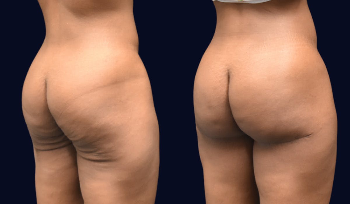 Brazilian Butt Lift Before & After Gallery - Patient 298724 - Image 2