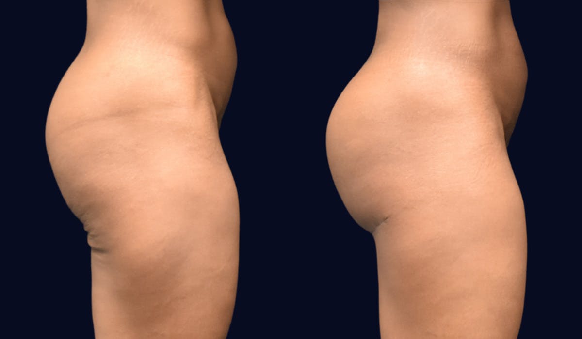 Brazilian Butt Lift Before & After Gallery - Patient 298724 - Image 3