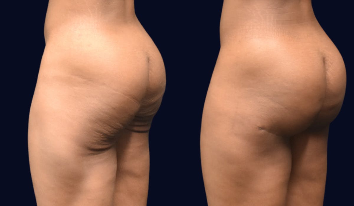 Brazilian Butt Lift Before & After Gallery - Patient 298724 - Image 4