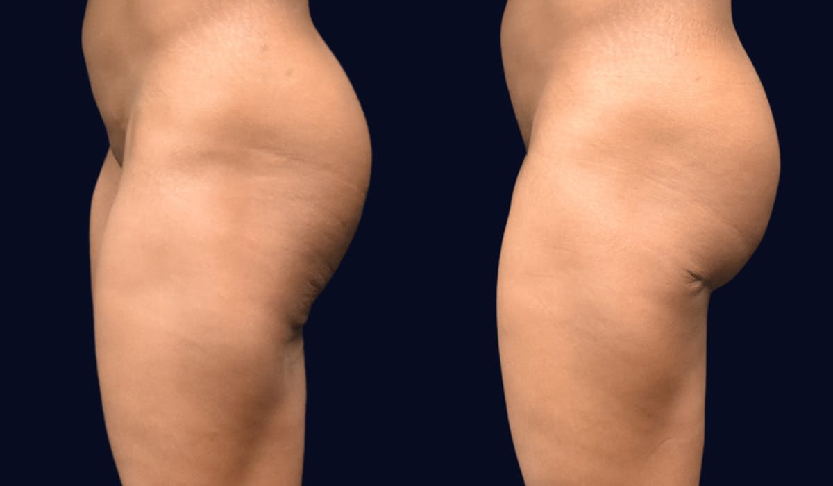 Brazilian Butt Lift Before & After Gallery - Patient 298724 - Image 5