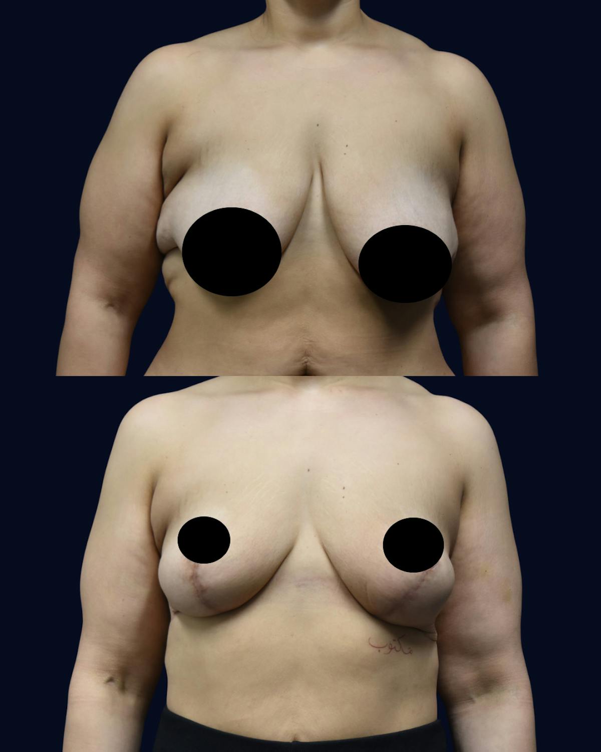 Breast Reduction and Lift Before & After Gallery - Patient 307852 - Image 1