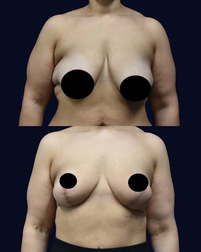 Breast Reduction and Lift Before & After Gallery - Patient 307852 - Image 1