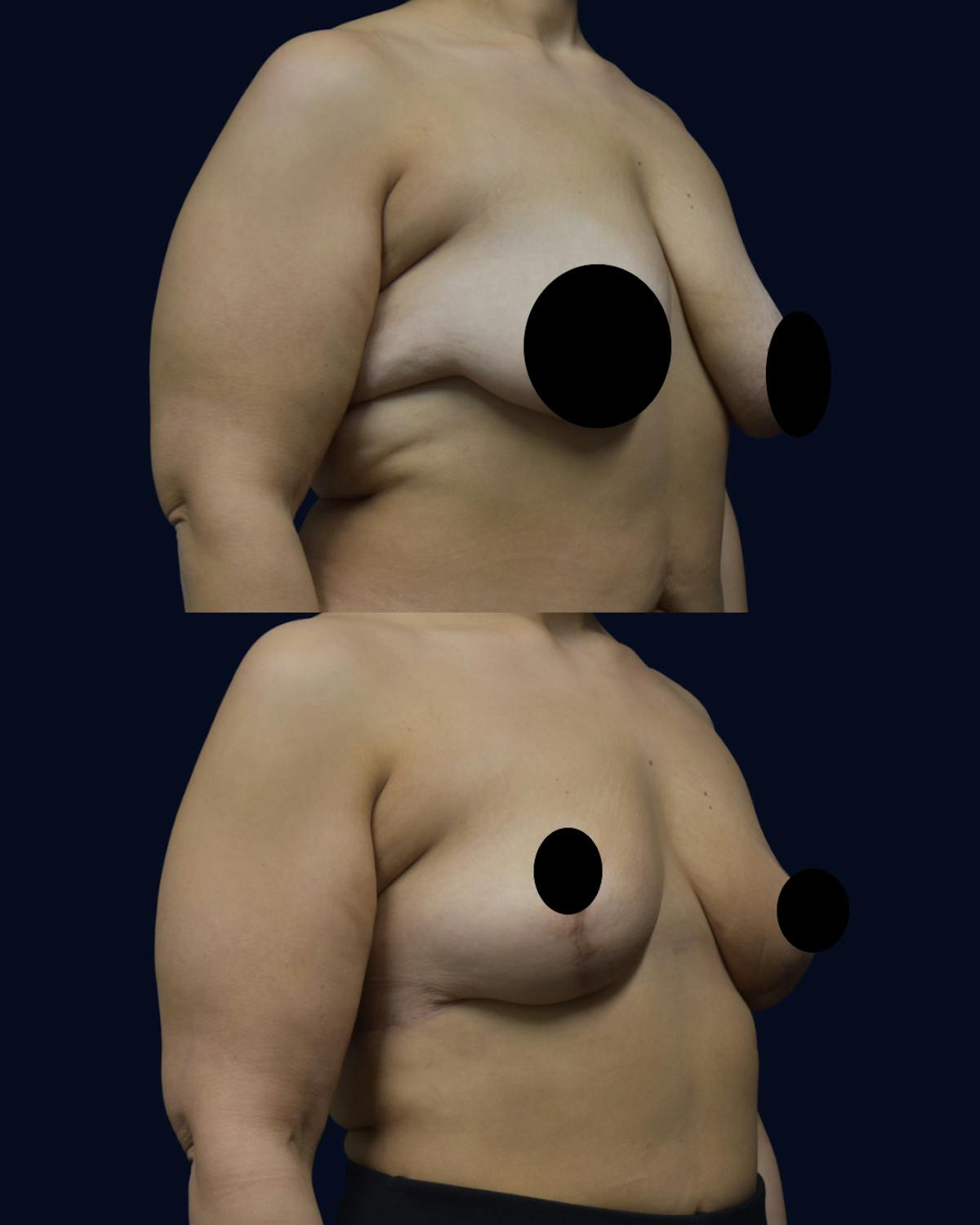Breast Reduction and Lift Before & After Gallery - Patient 307852 - Image 2