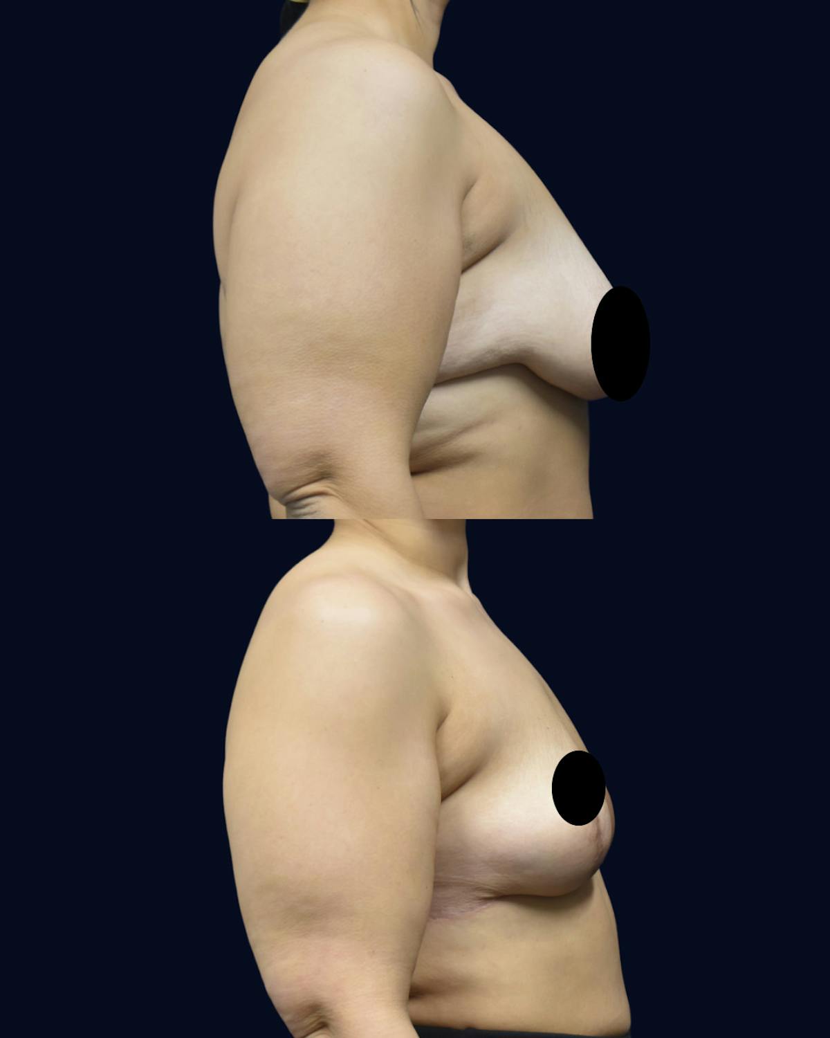 Breast Reduction and Lift Before & After Gallery - Patient 307852 - Image 3