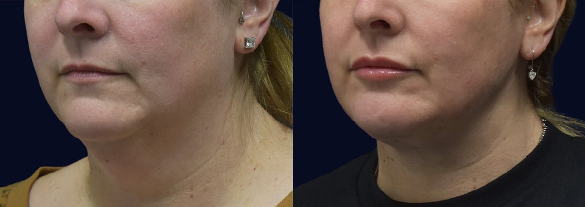 Neck Lift Before & After Gallery - Patient 121211 - Image 2
