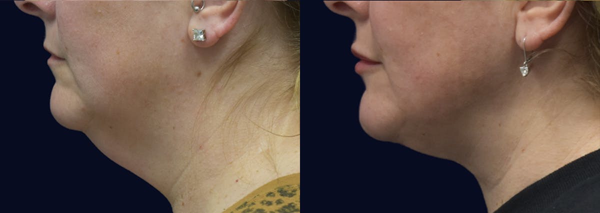 Neck Lift Before & After Gallery - Patient 121211 - Image 1