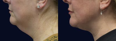Neck Lift Before & After Gallery - Patient 121211 - Image 1