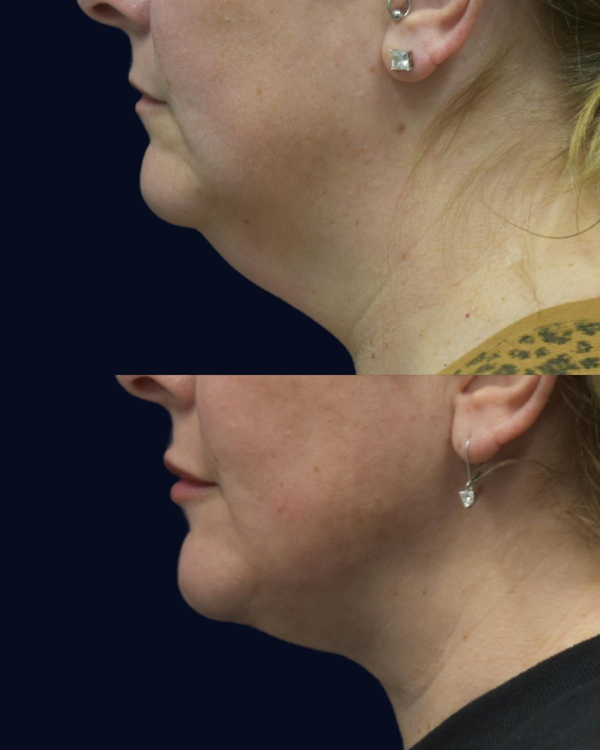 CO2 Laser Before & After Gallery - Patient 800779 - Image 1