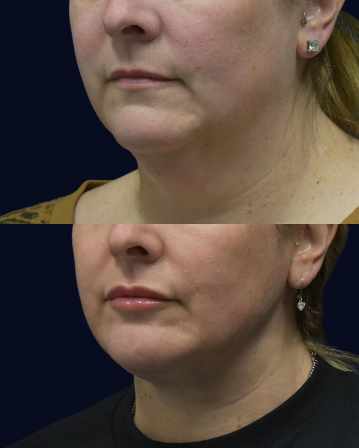 CO2 Laser Before & After Gallery - Patient 800779 - Image 2