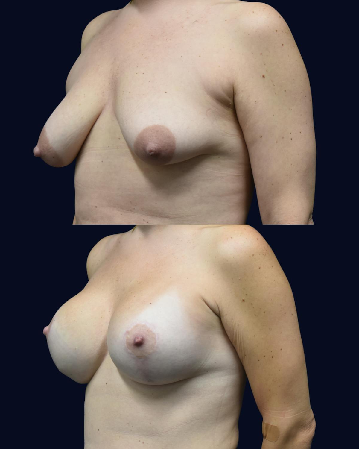 Breast Lift Before & After Gallery - Patient 428901 - Image 2