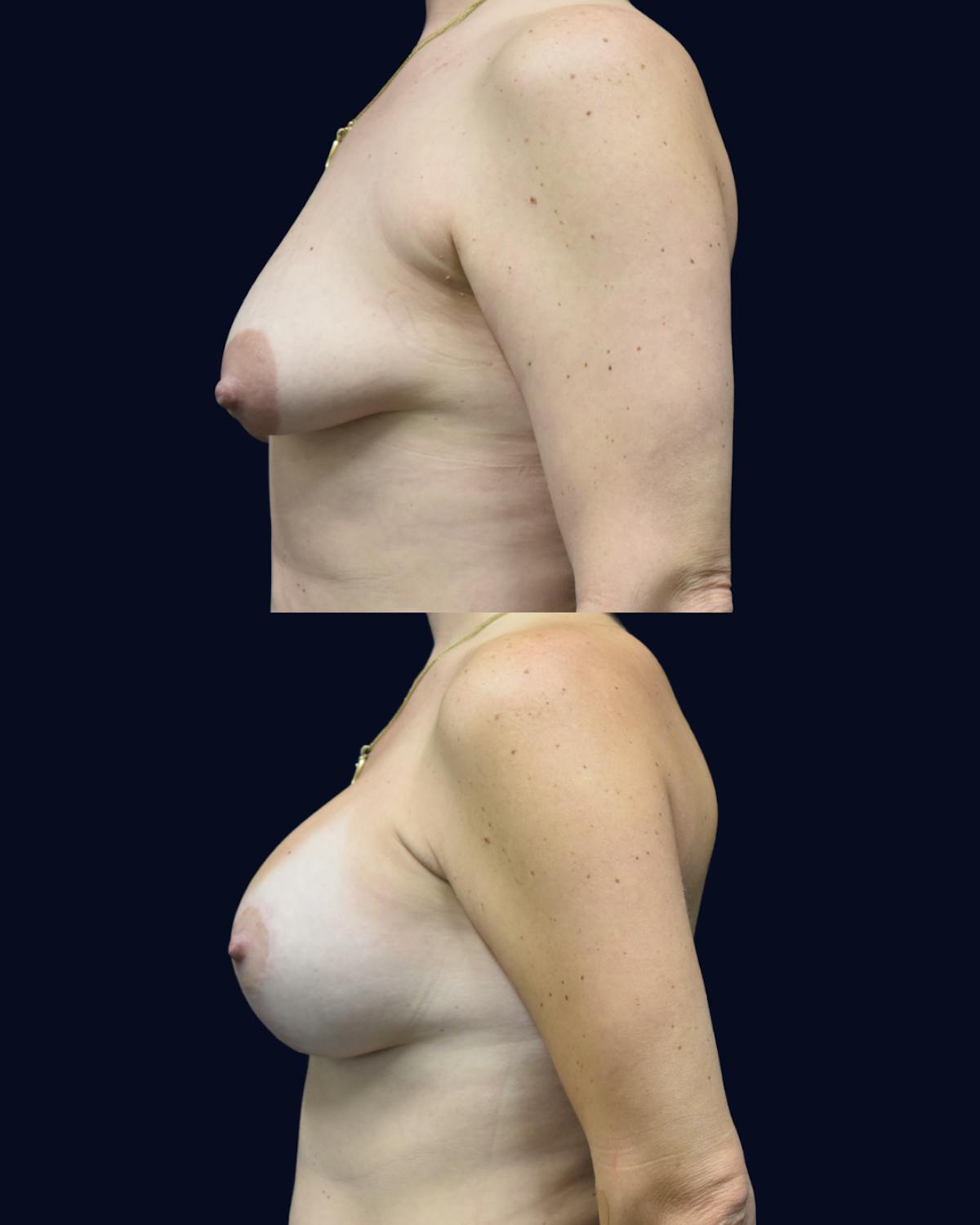 Breast Lift Before & After Gallery - Patient 428901 - Image 3