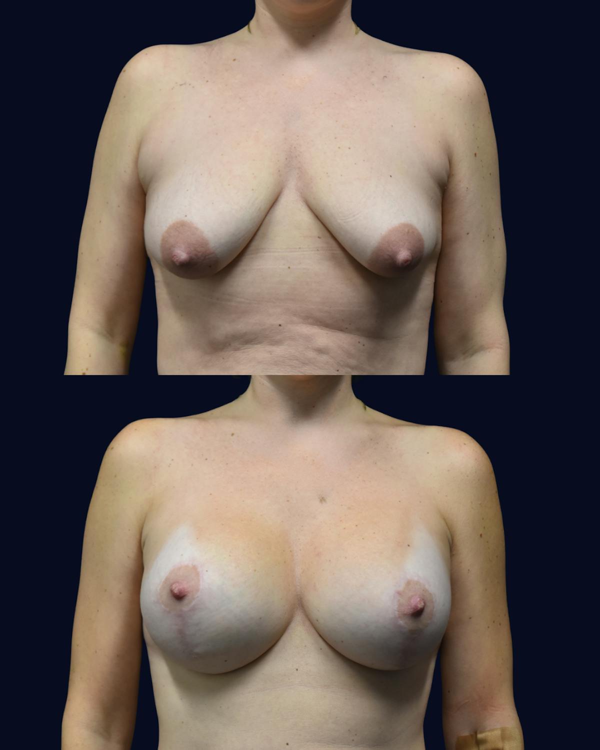 Breast Lift Before & After Gallery - Patient 428901 - Image 1