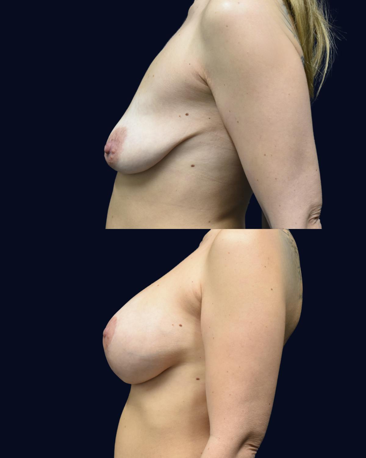 Breast Lift Before & After Gallery - Patient 101115 - Image 4