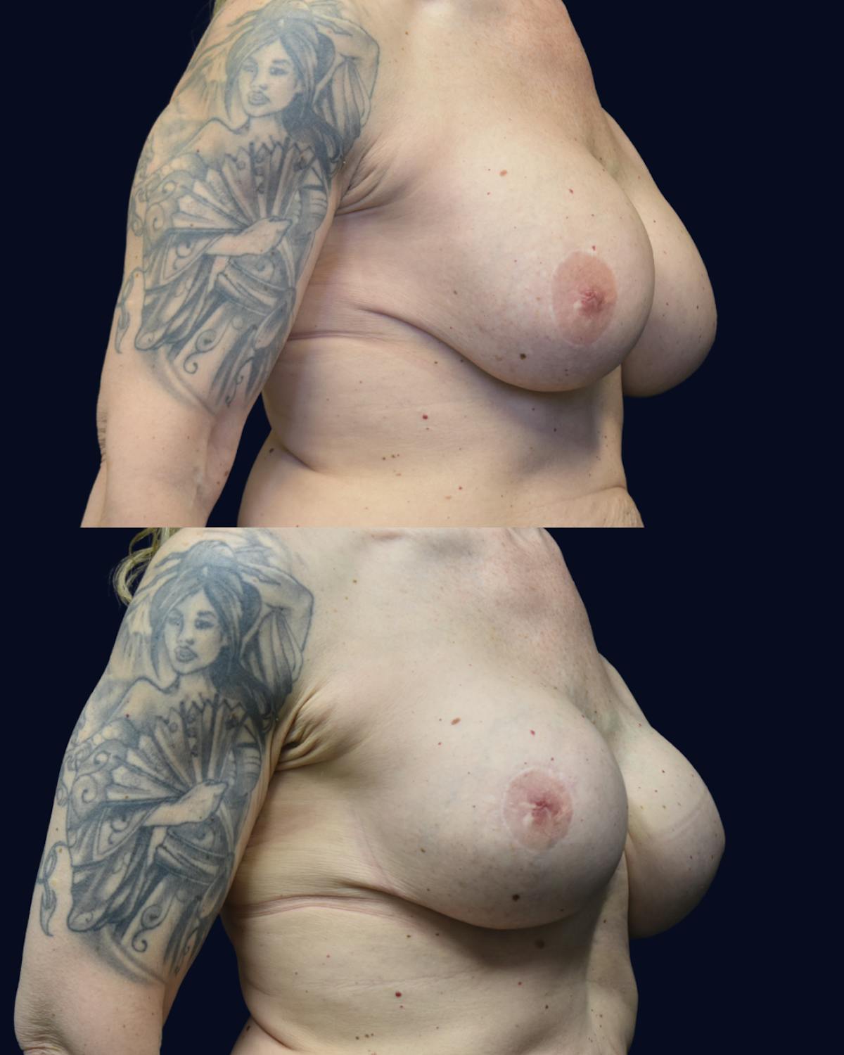 Breast Lift Before & After Gallery - Patient 236150 - Image 2