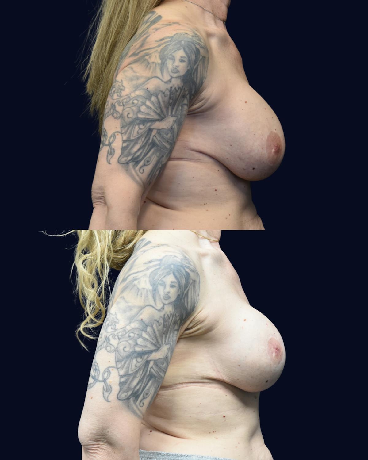 Breast Lift Before & After Gallery - Patient 236150 - Image 3