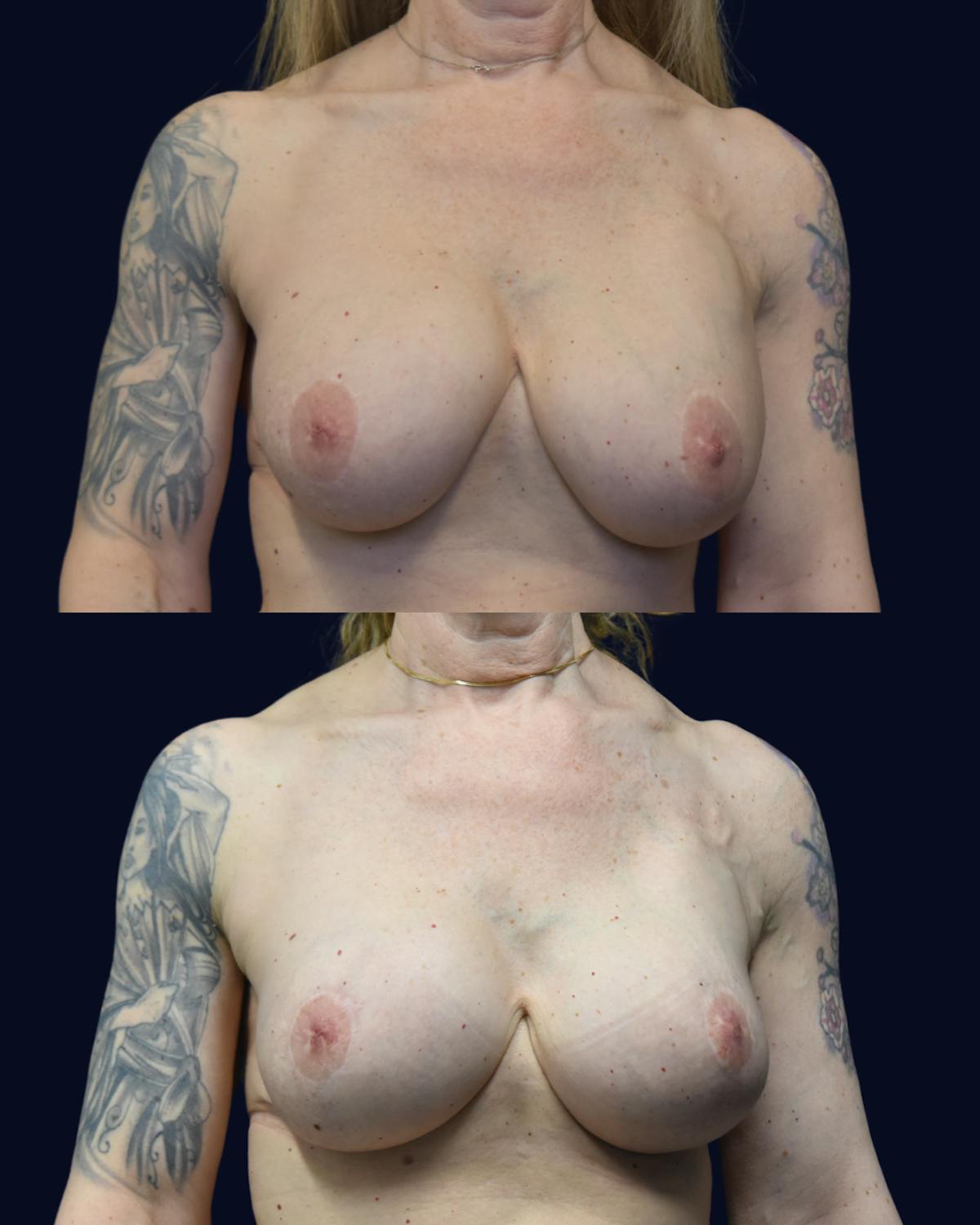Breast Lift Before & After Gallery - Patient 236150 - Image 1