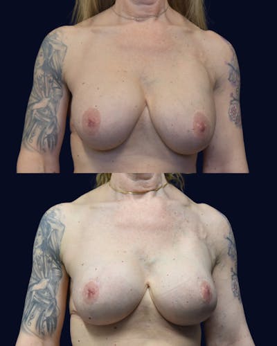 Breast Lift Before & After Gallery - Patient 236150 - Image 1