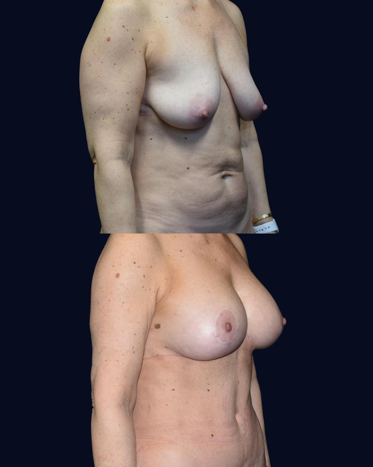 Mommy Makeover Before & After Gallery - Patient 384295 - Image 3