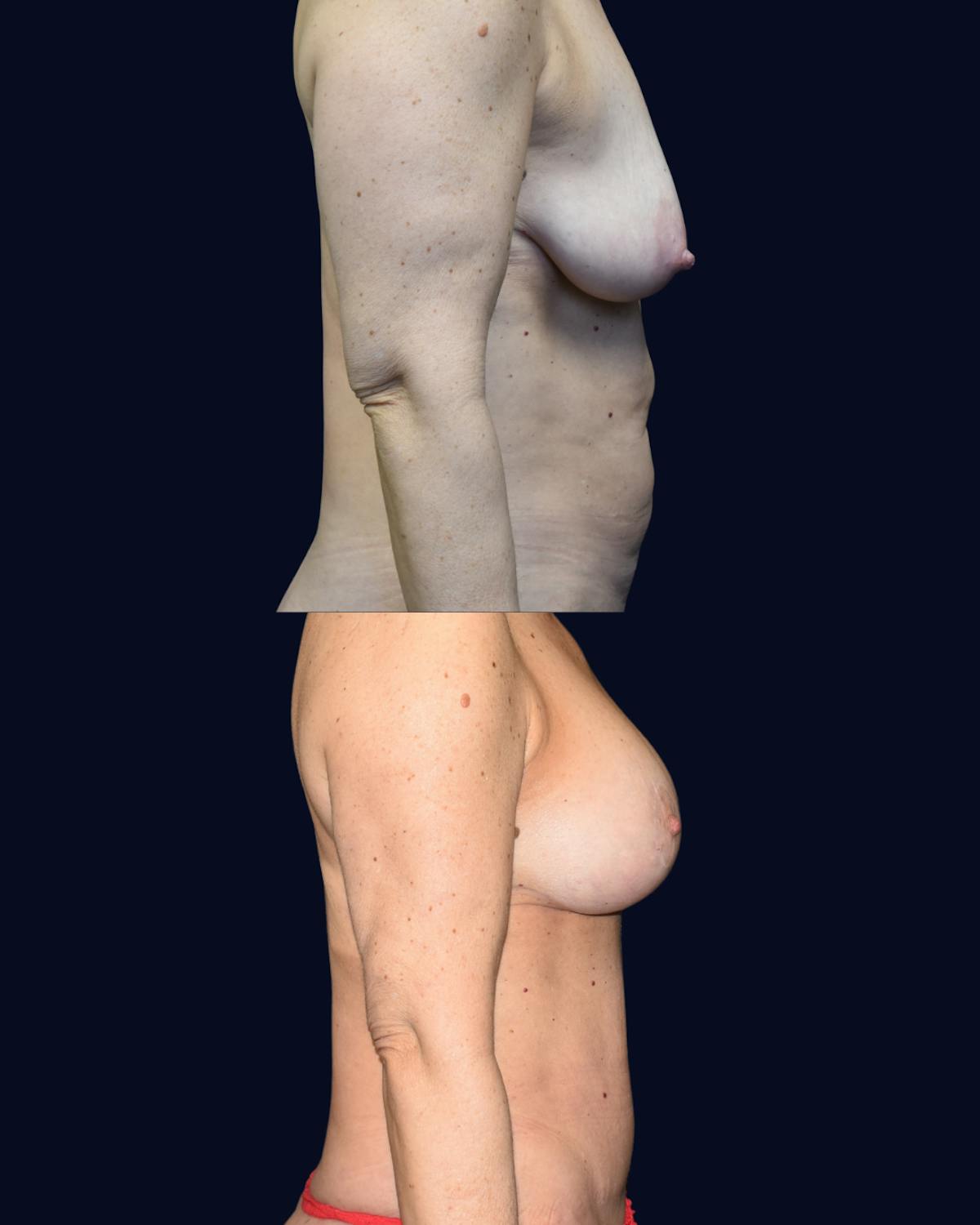 Mommy Makeover Before & After Gallery - Patient 384295 - Image 4