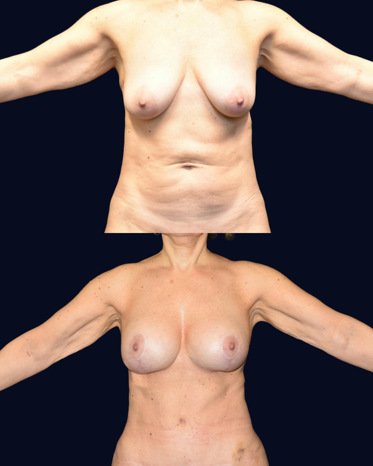 Mommy Makeover Before & After Gallery - Patient 384295 - Image 2