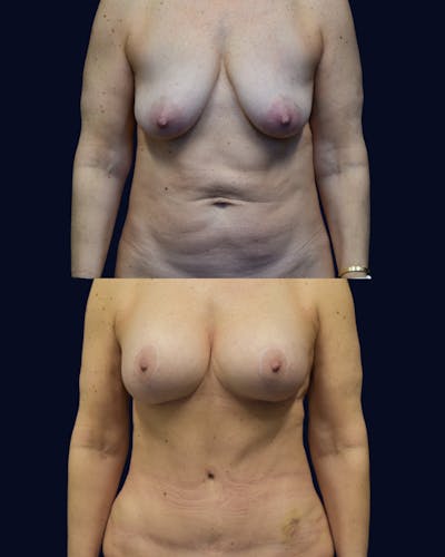 Breast Lift with Implants Before & After Gallery - Patient 938689 - Image 1