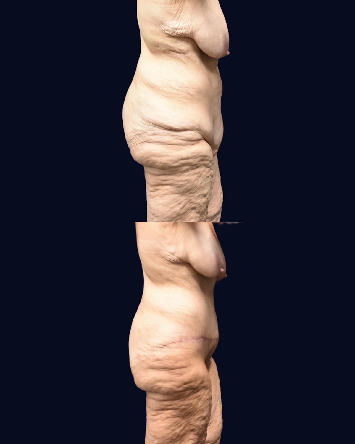 Fleur de Lis Before & After Gallery - Patient 412732 - Image 3