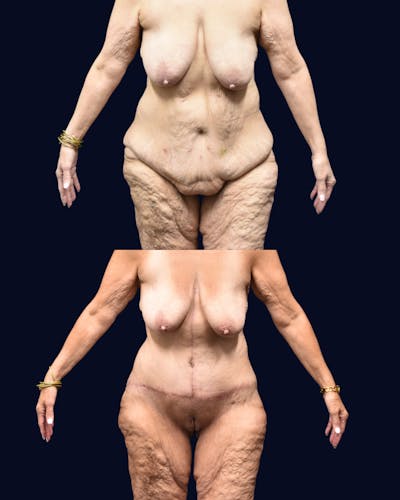 Fleur de Lis Before & After Gallery - Patient 412732 - Image 1
