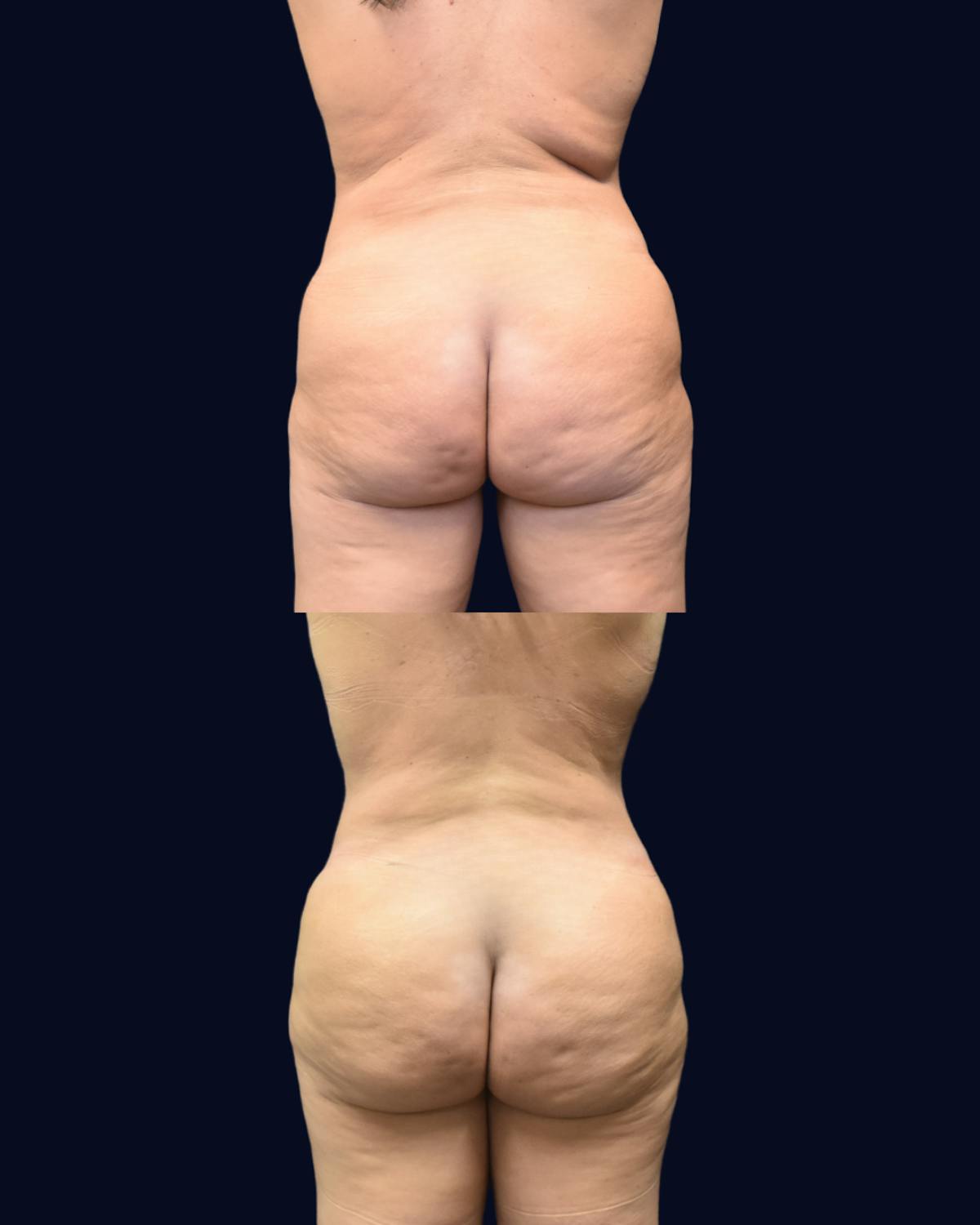 Brazilian Butt Lift Before & After Gallery - Patient 495373 - Image 1