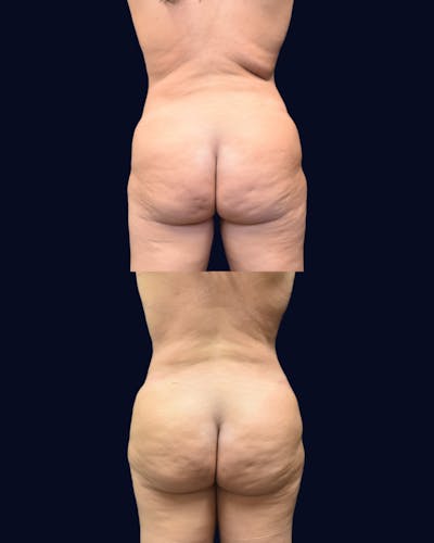 Brazilian Butt Lift Before & After Gallery - Patient 495373 - Image 1