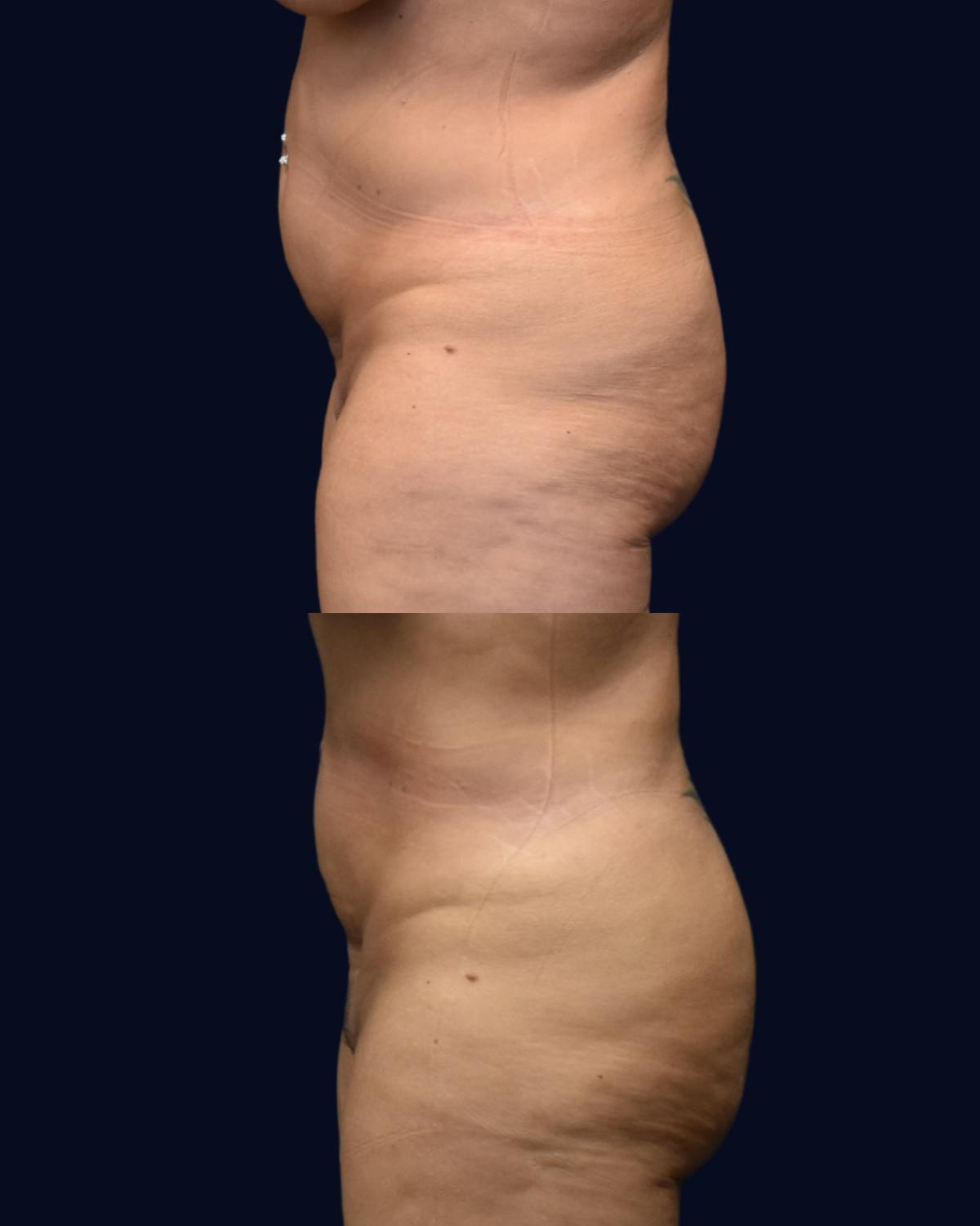 Brazilian Butt Lift Before & After Gallery - Patient 495373 - Image 2