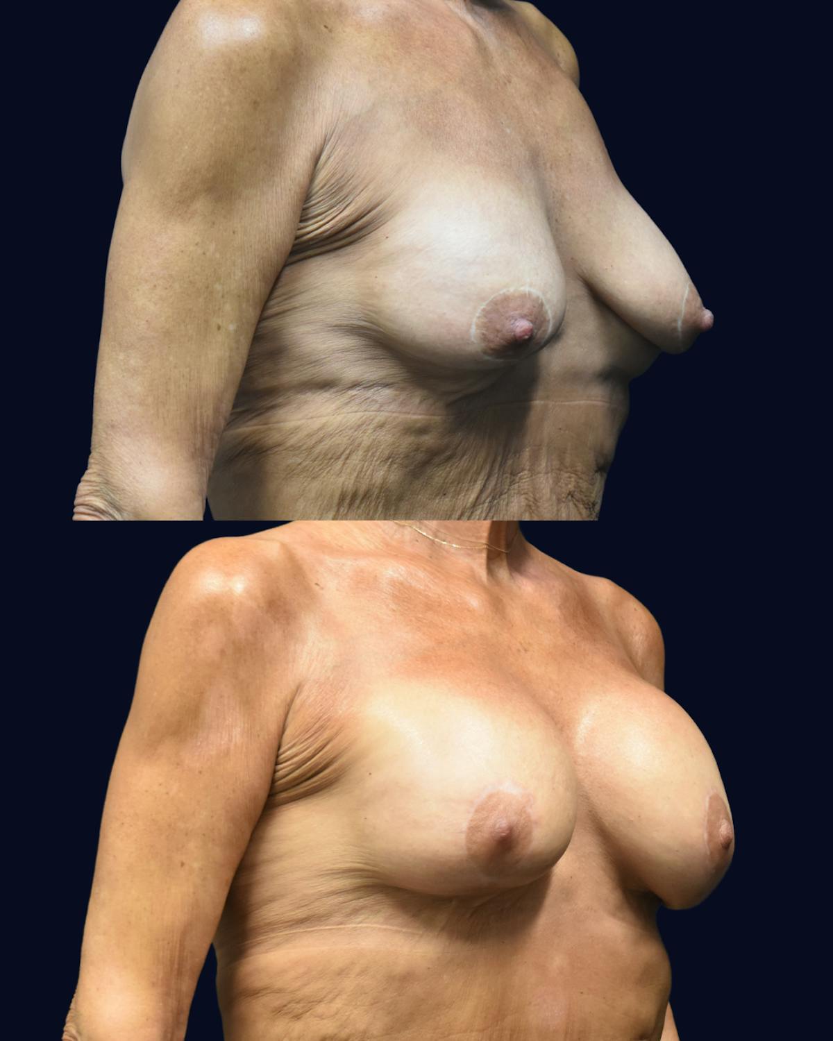 Breast Lift with Implants Before & After Gallery - Patient 202823 - Image 2