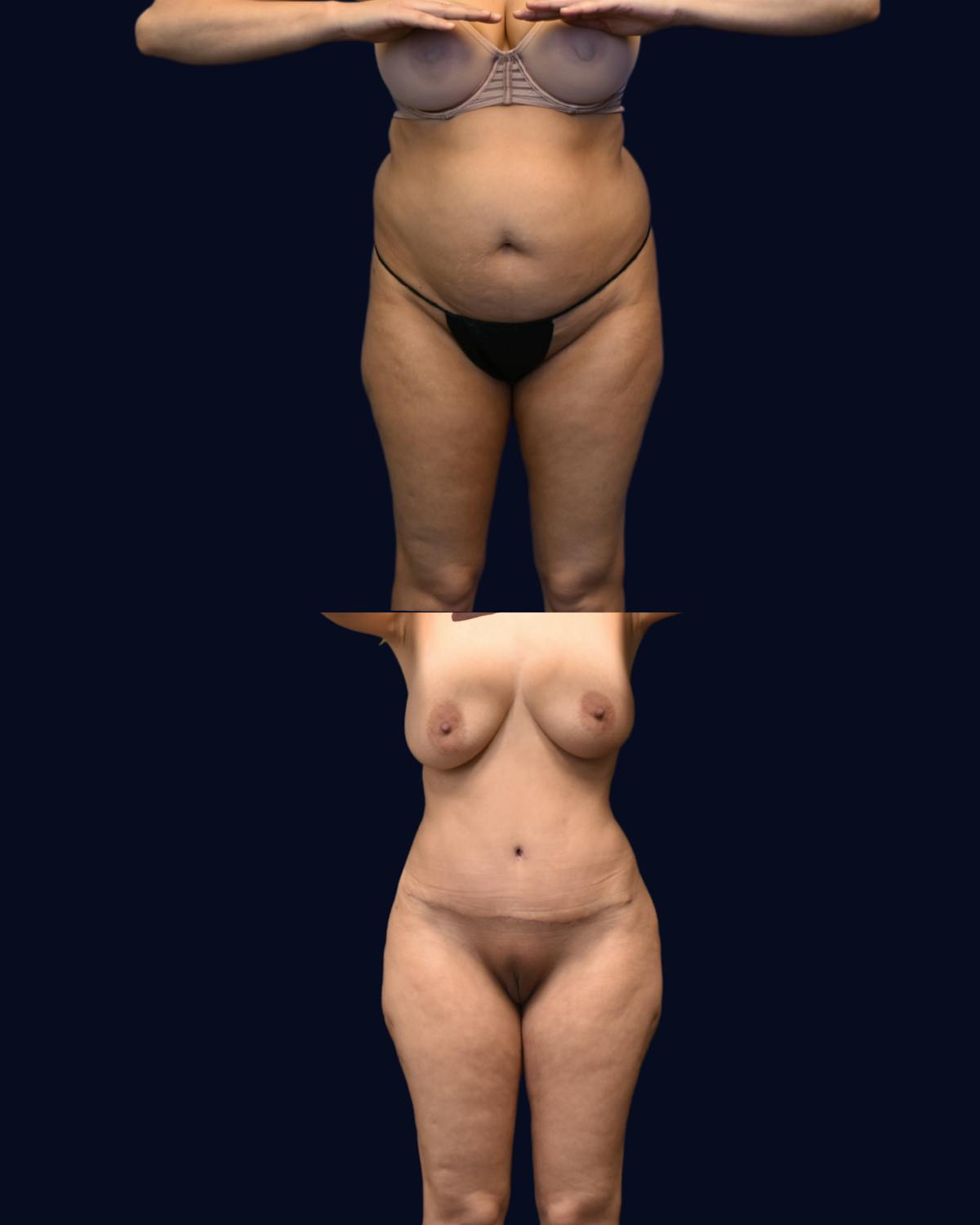 Abdominoplasty with Liposuction Before & After Gallery - Patient 285936 - Image 2