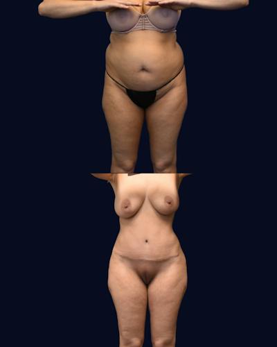 Abdominoplasty with Liposuction Before & After Gallery - Patient 285936 - Image 1