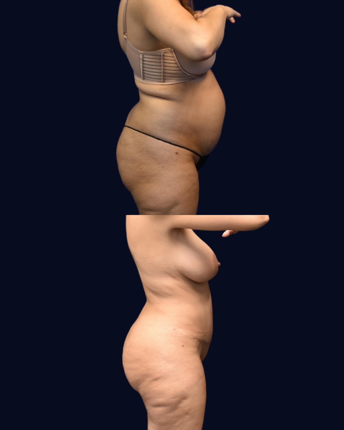 Abdominoplasty with Liposuction Before & After Gallery - Patient 285936 - Image 3