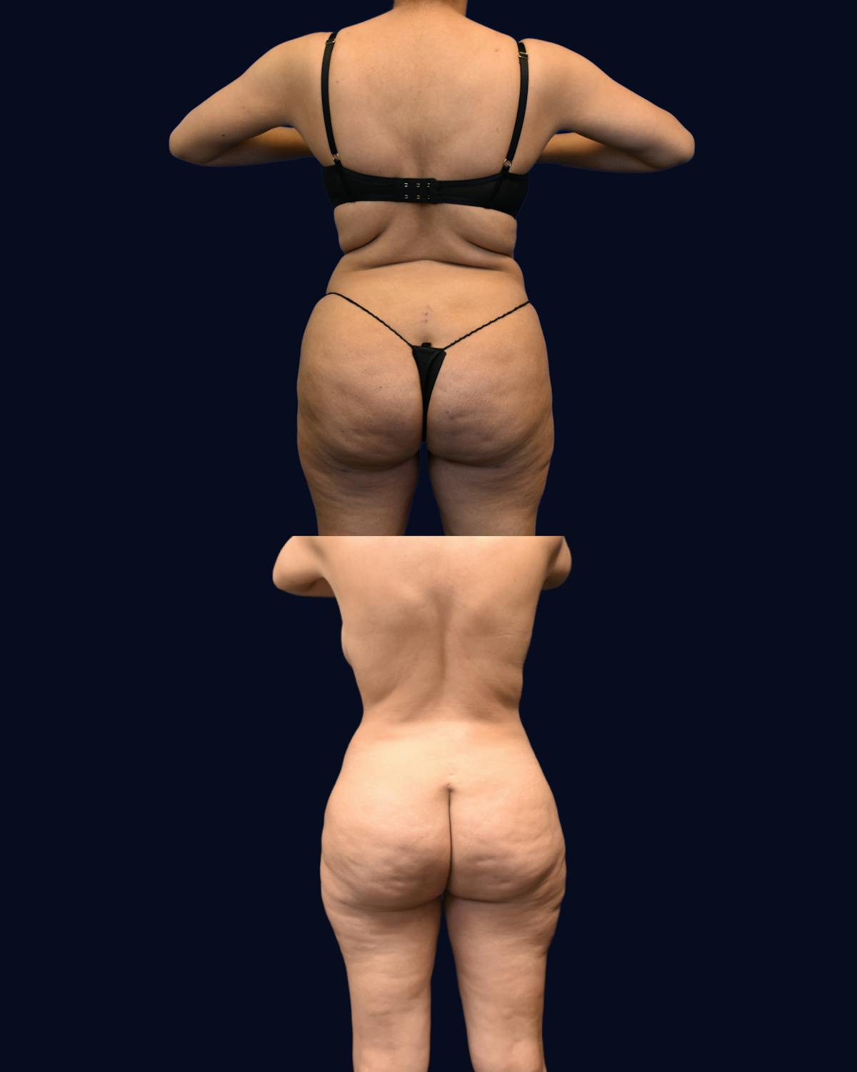 Abdominoplasty with Liposuction Before & After Gallery - Patient 285936 - Image 6