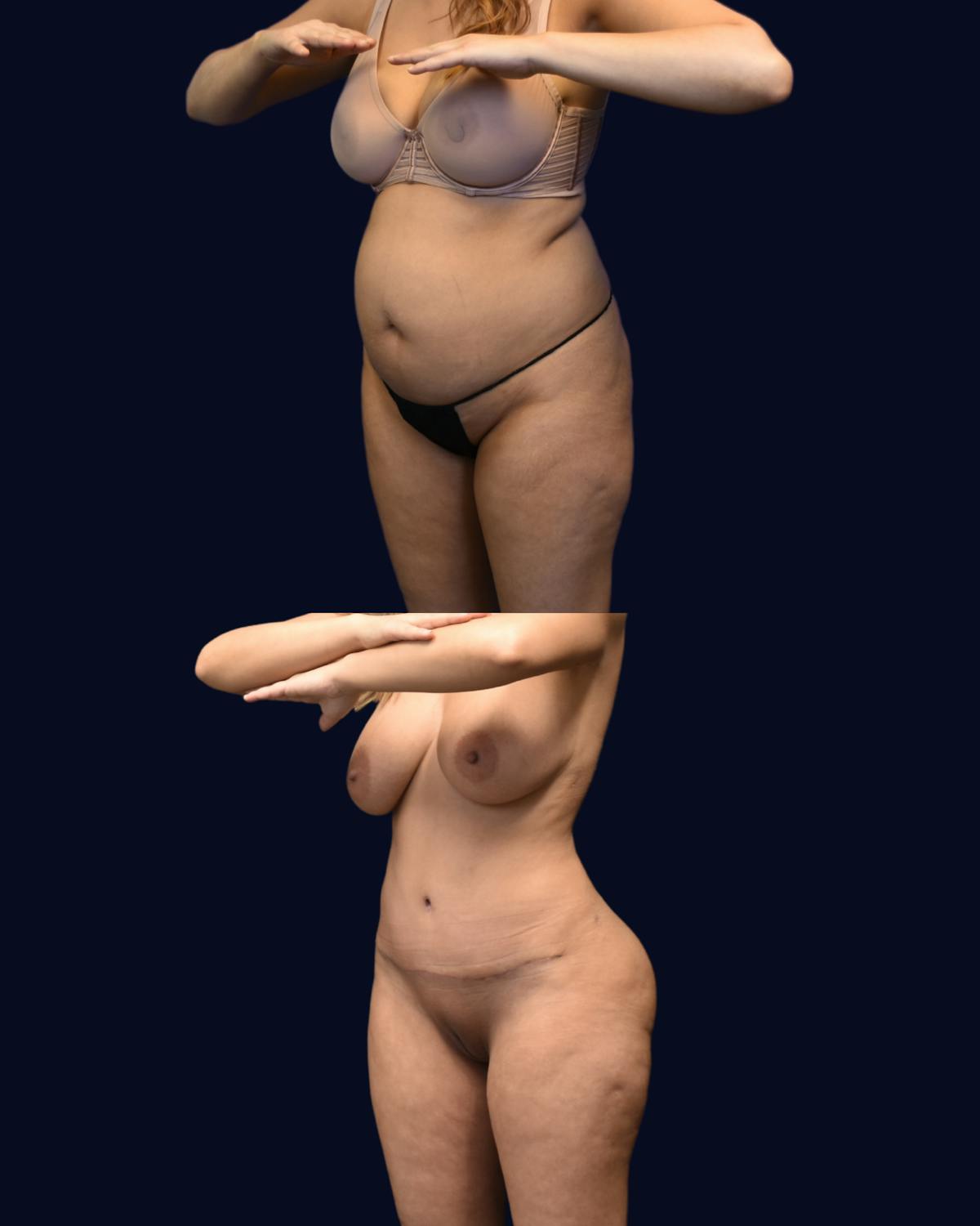 Abdominoplasty with Liposuction Before & After Gallery - Patient 285936 - Image 4