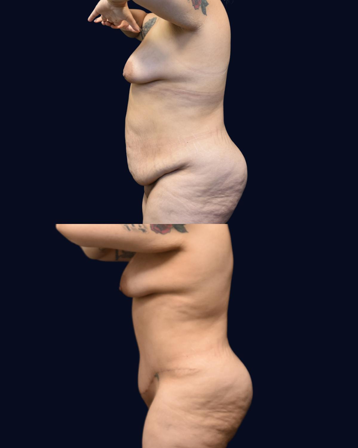 Abdominoplasty (Tummy Tuck) Before & After Gallery - Patient 389480 - Image 3
