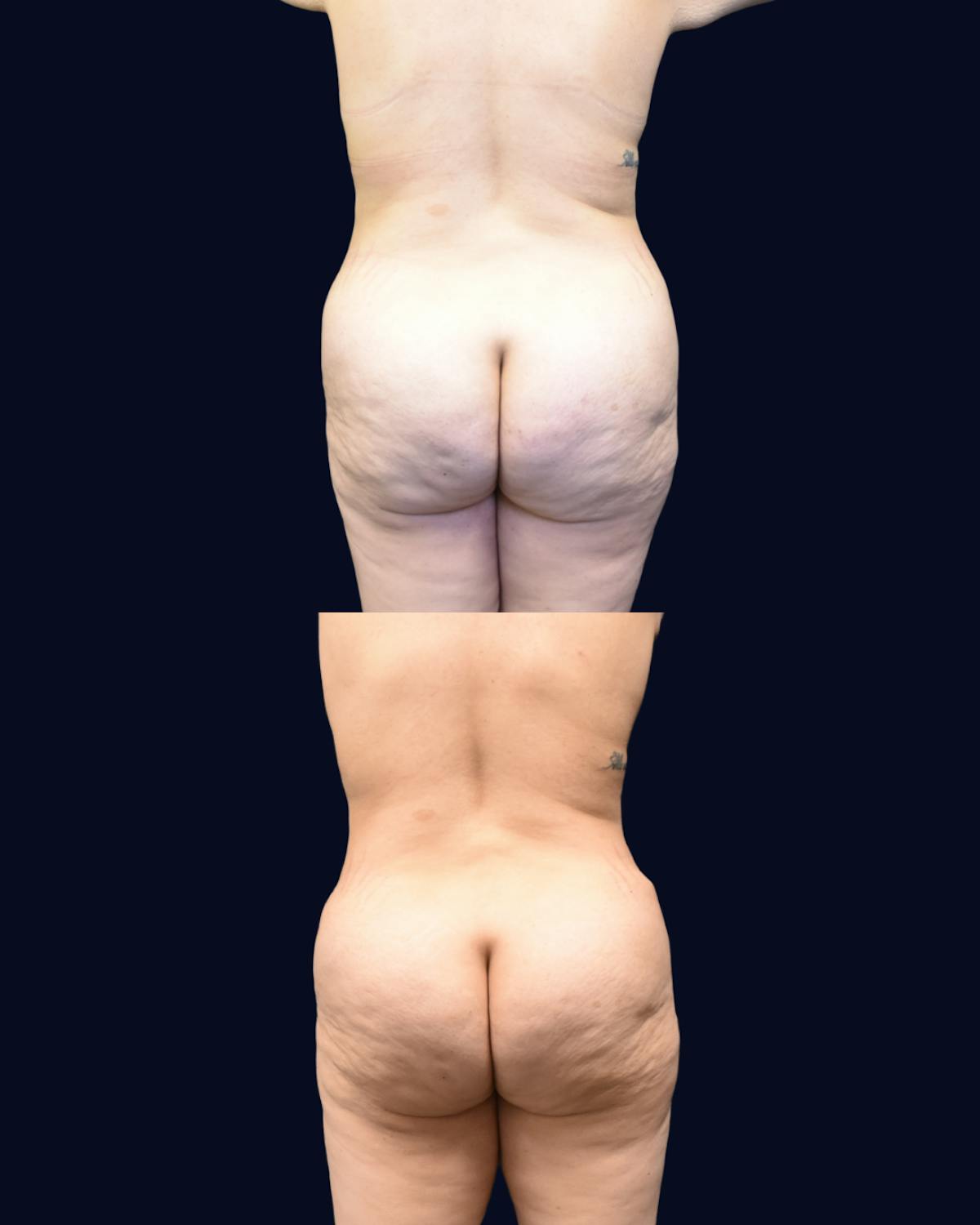 Abdominoplasty (Tummy Tuck) Before & After Gallery - Patient 389480 - Image 4