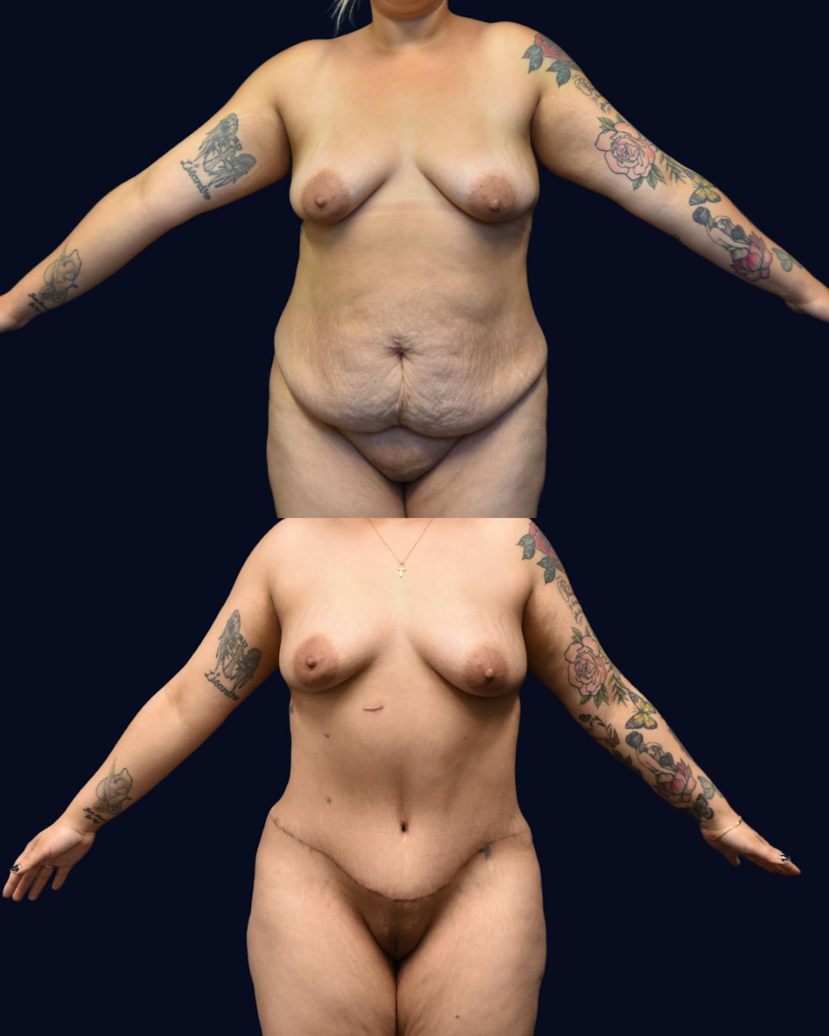 Abdominoplasty (Tummy Tuck) Before & After Gallery - Patient 389480 - Image 1