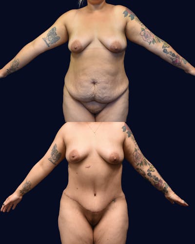Abdominoplasty (Tummy Tuck) Before & After Gallery - Patient 389480 - Image 1