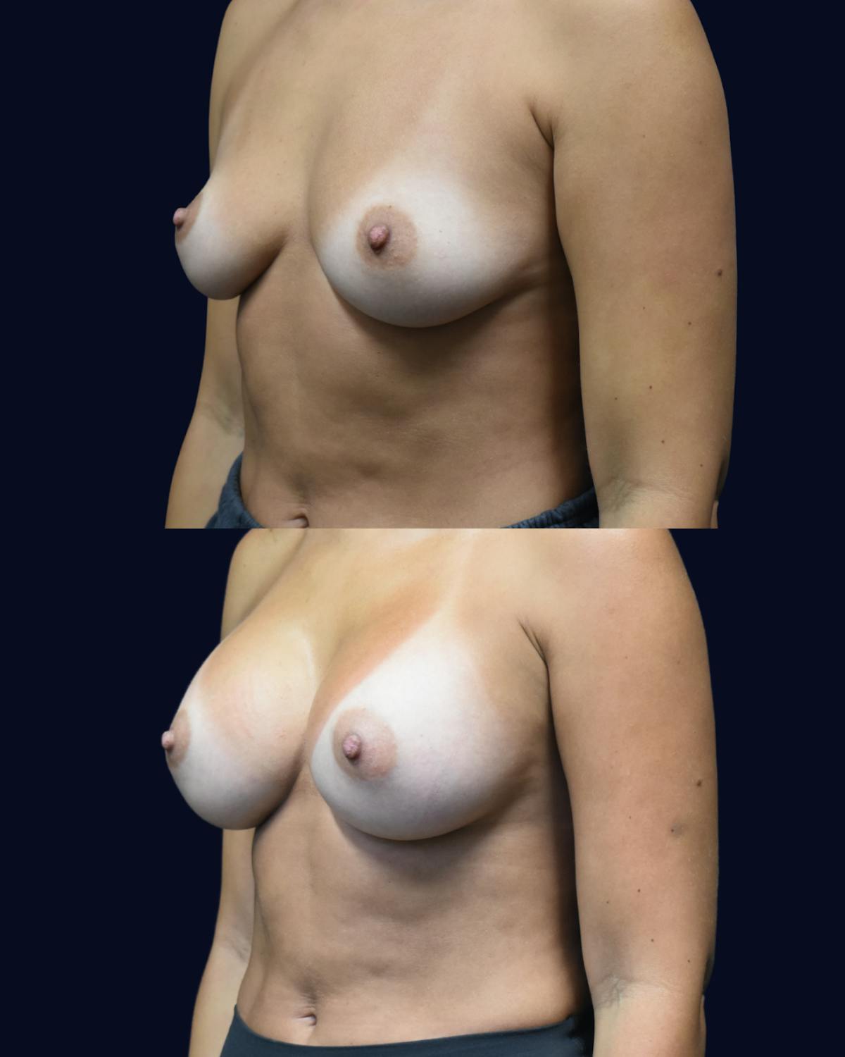 Breast Augmentation Before & After Gallery - Patient 102994 - Image 3