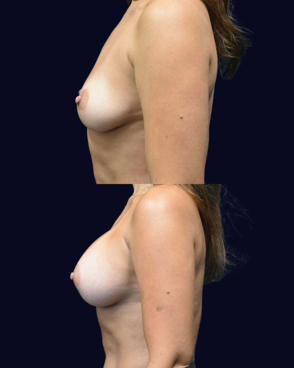 Breast Augmentation Before & After Gallery - Patient 102994 - Image 2