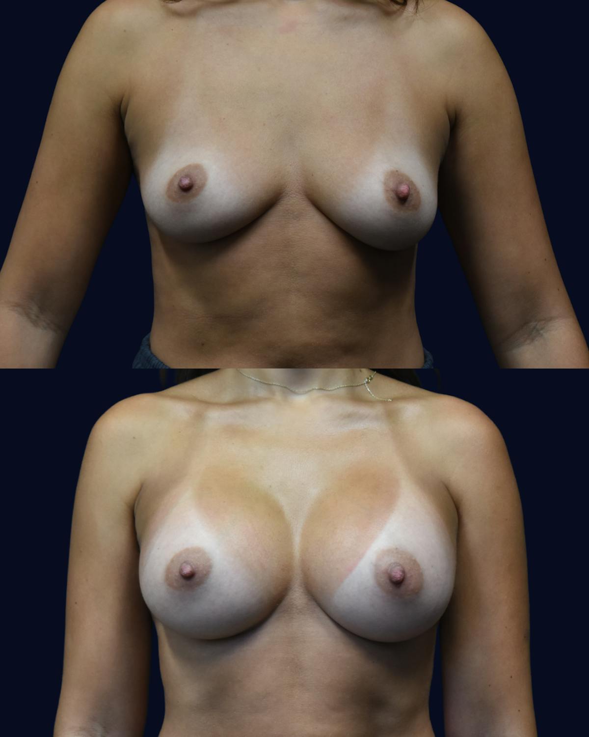 Breast Augmentation Before & After Gallery - Patient 102994 - Image 1