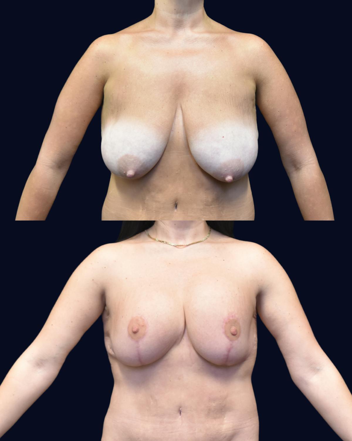 Breast Reduction and Lift with Implants Before & After Gallery - Patient 198247 - Image 1